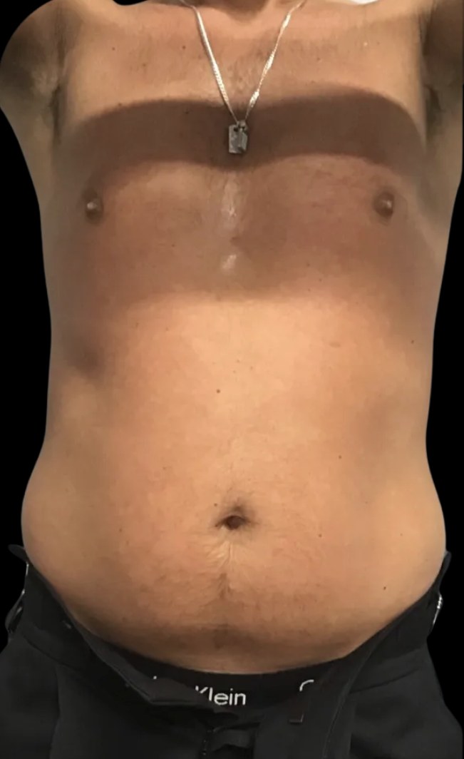 Wellness Rx Membership before treatment at Juvly Aesthetics
