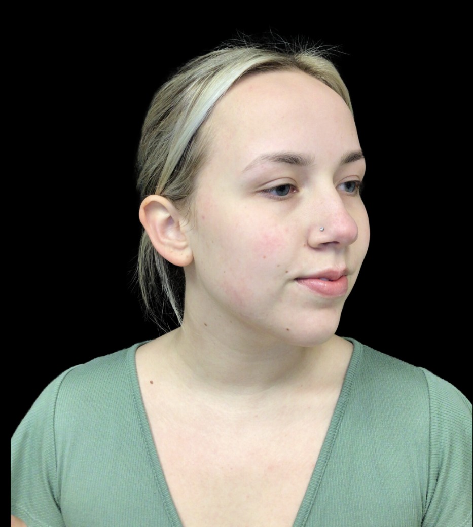 Chin Filler after treatment at Juvly Aesthetics