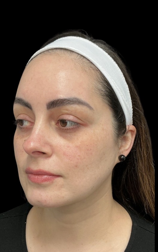 XTherma after treatment at Juvly Aesthetics