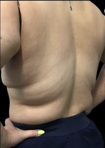 CoolSculpting before treatment at Juvly Aesthetics