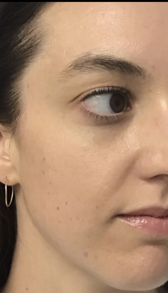Standard Microneedling after treatment at Juvly Aesthetics