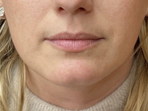 Lip filler before treatment at Juvly Aesthetics