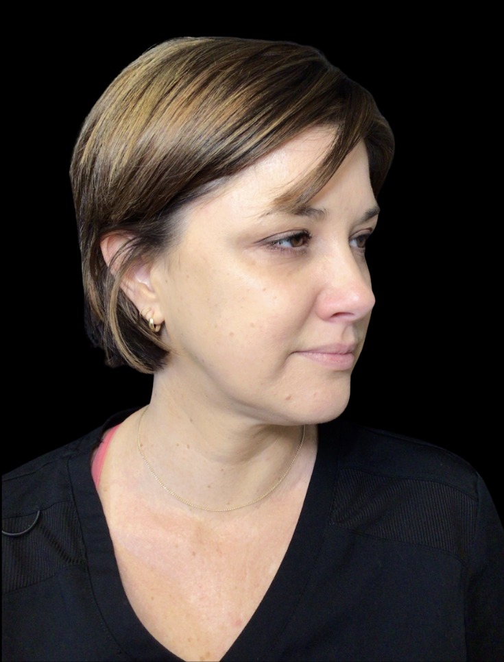 JLyft Non-Surgical Facelift before treatment at Juvly Aesthetics