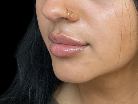 Lip filler after treatment at Juvly Aesthetics