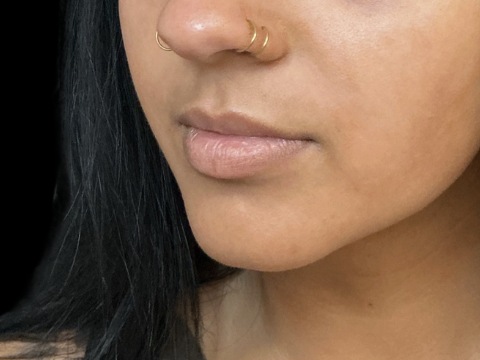Lip filler before treatment at Juvly Aesthetics