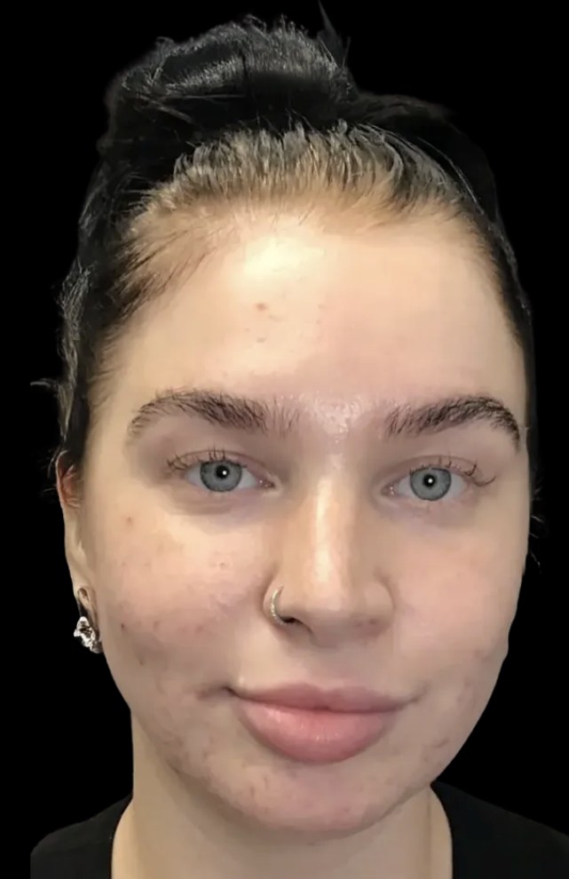 Standard Microneedling before treatment at Juvly Aesthetics