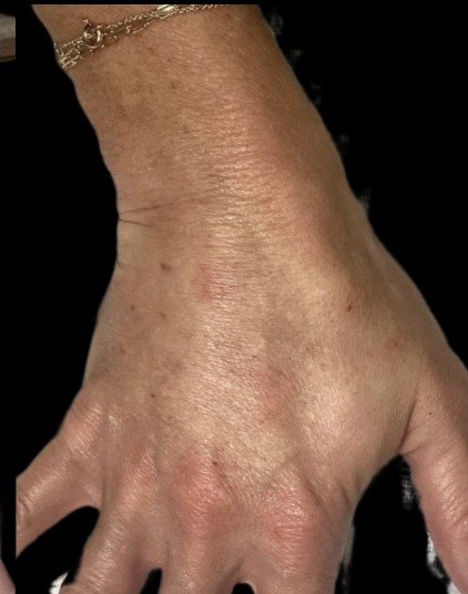 Hand filler after treatment at Juvly Aesthetics