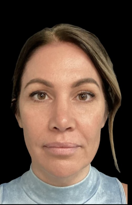 Under-Eye Treatments after treatment at Juvly Aesthetics