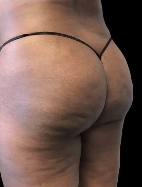Non-Surgical BBL after treatment at Juvly Aesthetics