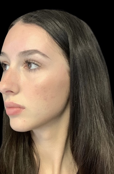 Standard Microneedling after treatment at Juvly Aesthetics