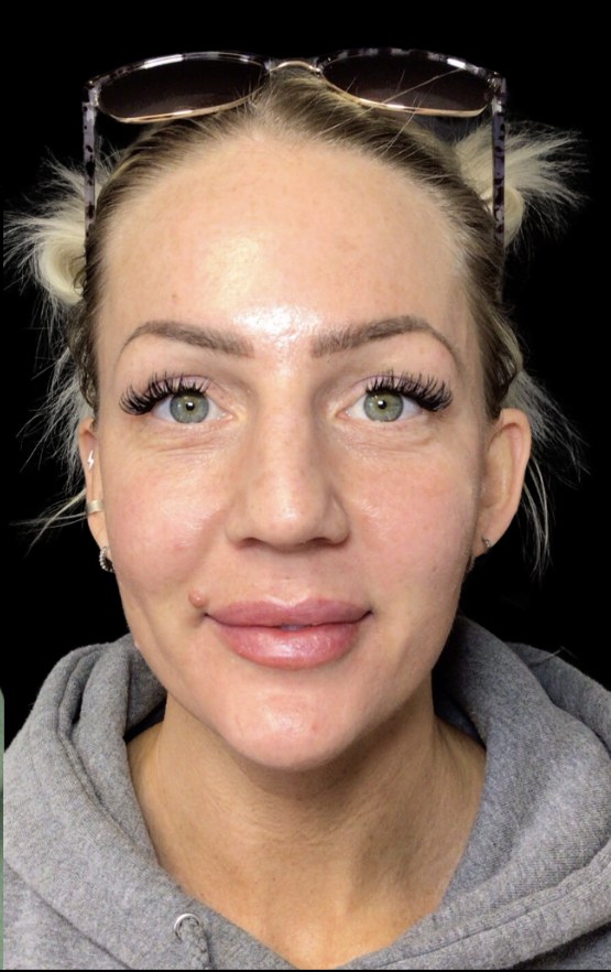 JLyft Non-Surgical Facelift after treatment at Juvly Aesthetics