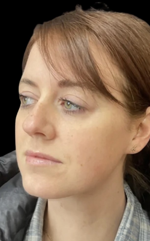 Lip filler before treatment at Juvly Aesthetics