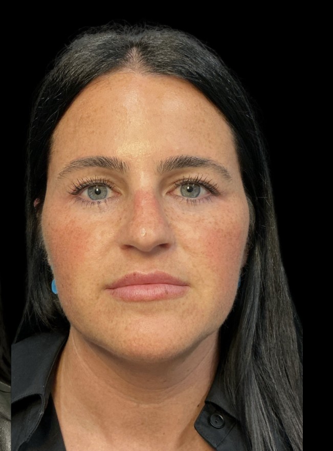 Masseter slimming after treatment at Juvly Aesthetics
