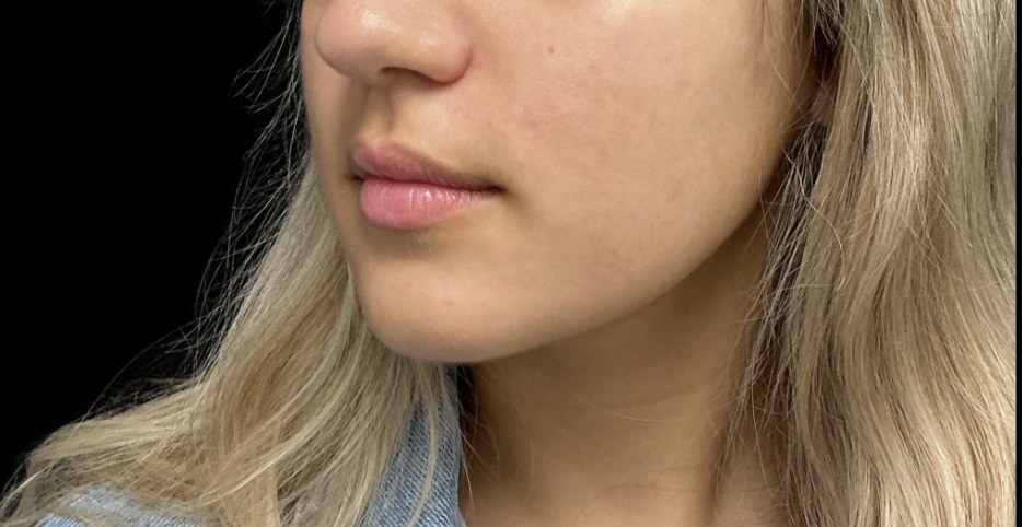 Lip filler before treatment at Juvly Aesthetics