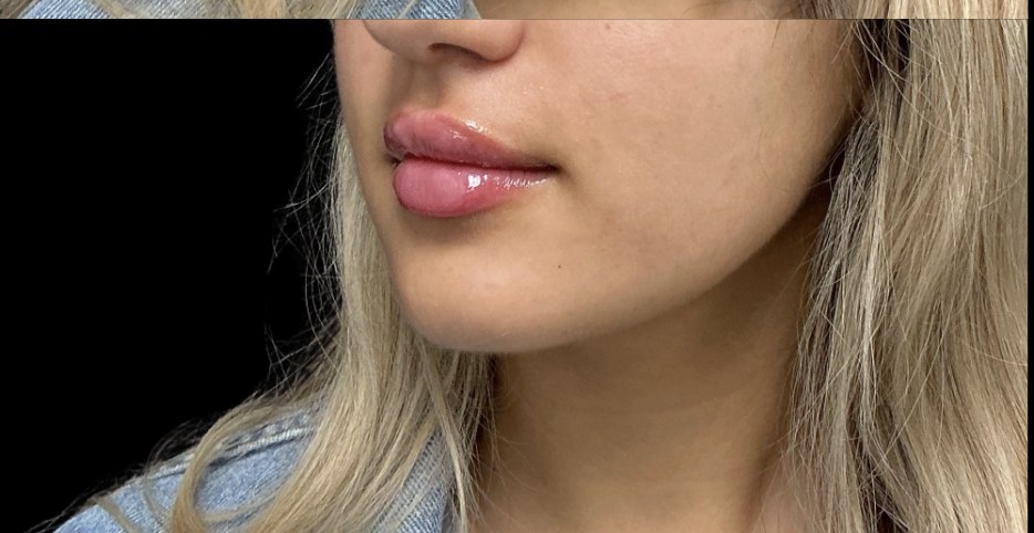 Lip filler after treatment at Juvly Aesthetics