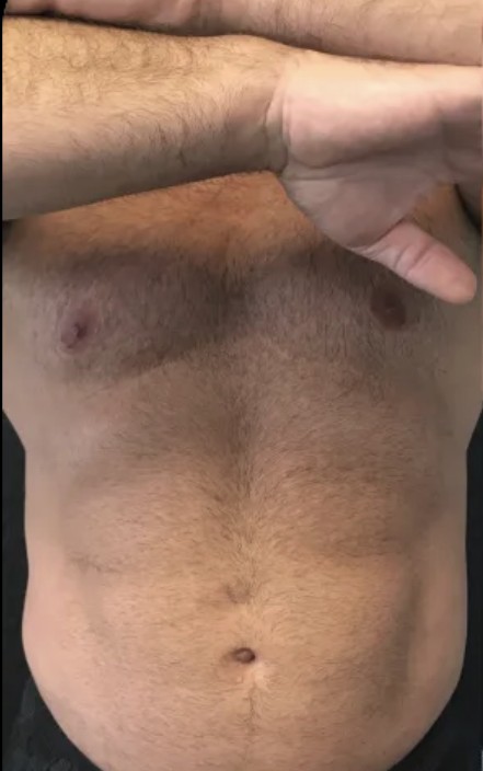 Kybella before treatment at Juvly Aesthetics