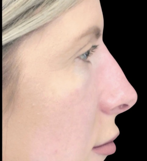 Liquid Nose Job after treatment at Juvly Aesthetics