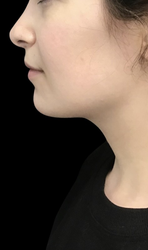 CoolSculpting Submental after treatment at Juvly Aesthetics