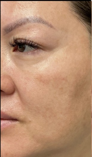 Chemical Peel before treatment at Juvly Aesthetics
