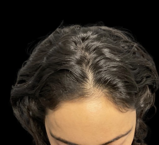 Hair Loss Treatments before treatment at Juvly Aesthetics
