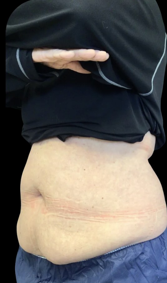 Wellness Rx Membership before treatment at Juvly Aesthetics