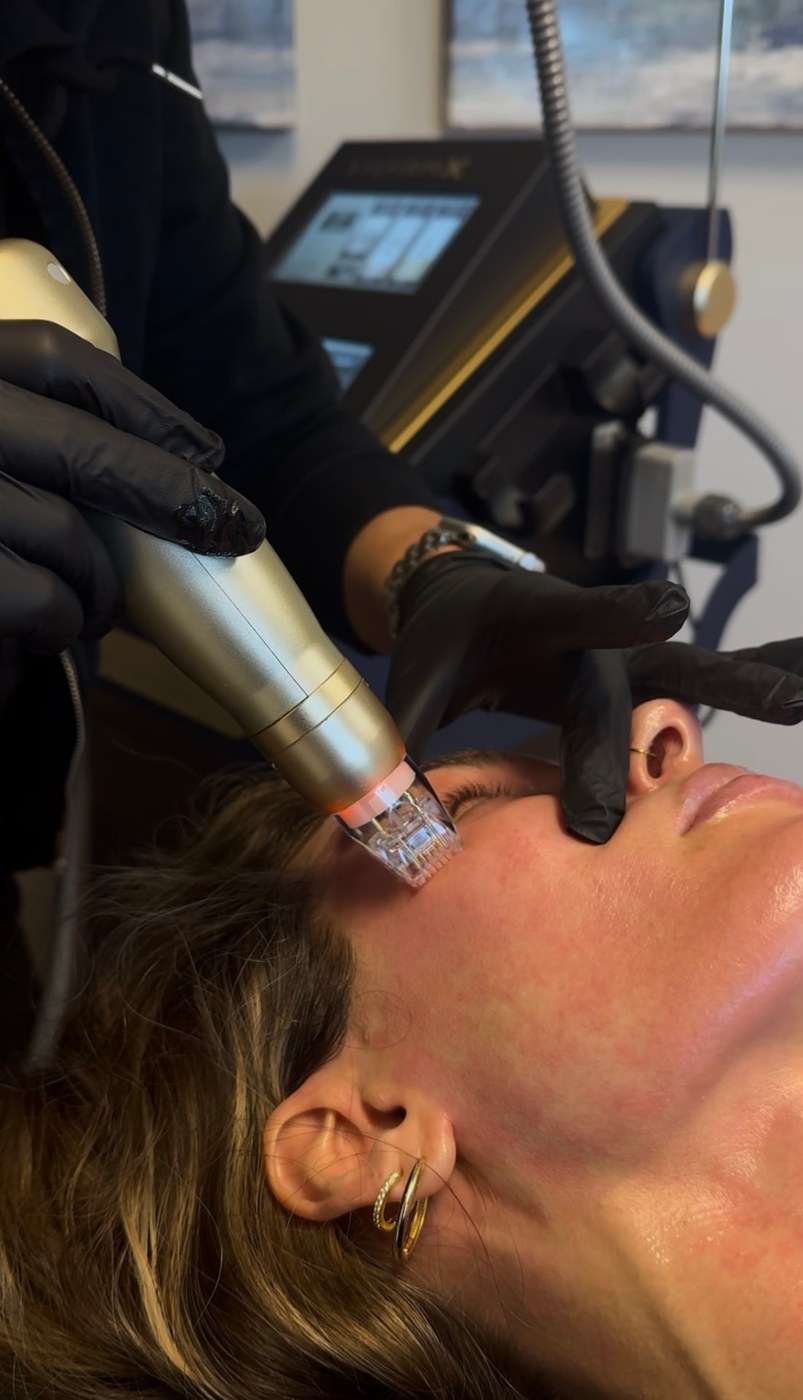 Sylfirm X handpiece treating the cheek during a session at Juvly Aesthetics