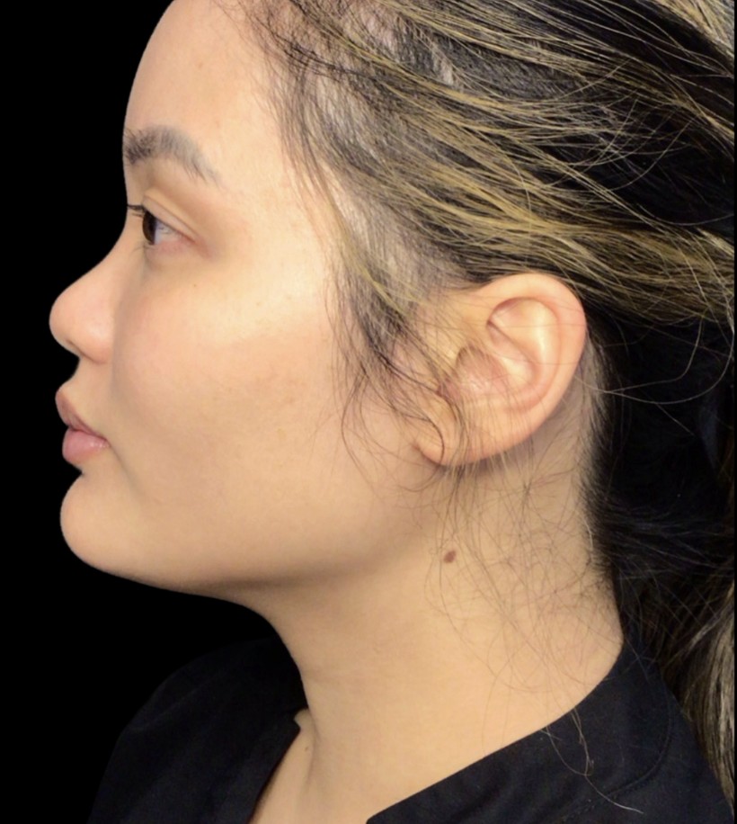 Kybella after treatment at Juvly Aesthetics