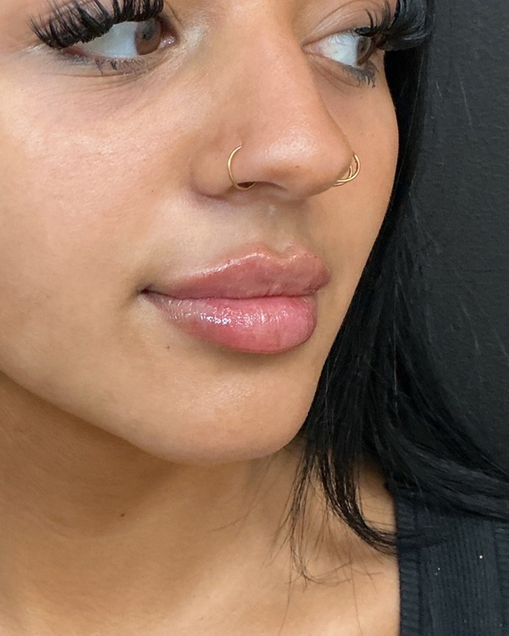 Lip filler after treatment at Juvly Aesthetics