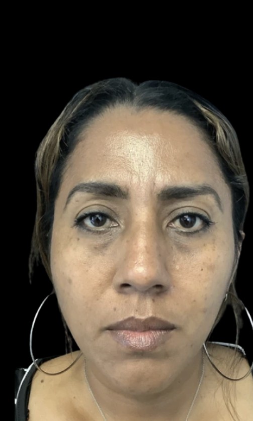 Under-Eye Treatments before treatment at Juvly Aesthetics