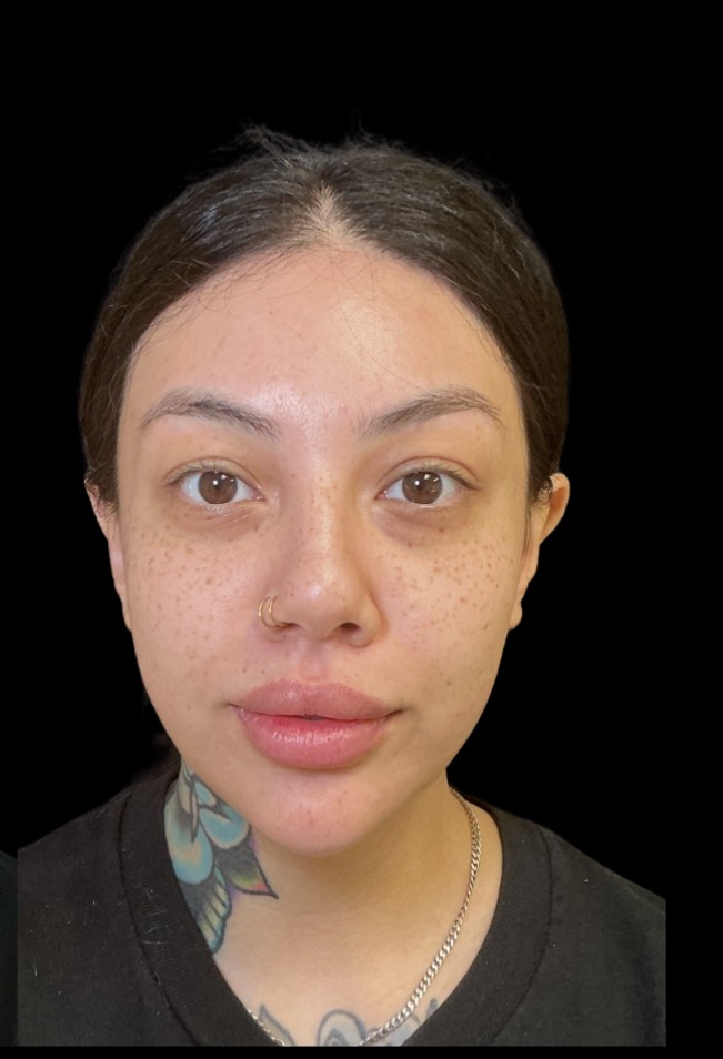Masseter slimming after treatment at Juvly Aesthetics
