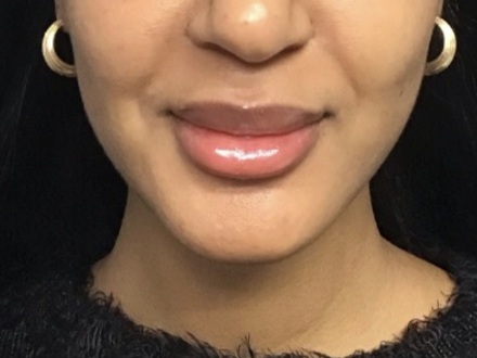 Lip filler after treatment at Juvly Aesthetics