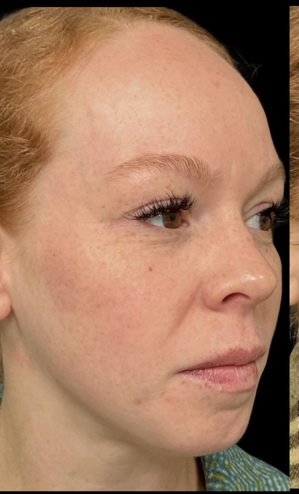 Laser before treatment at Juvly Aesthetics