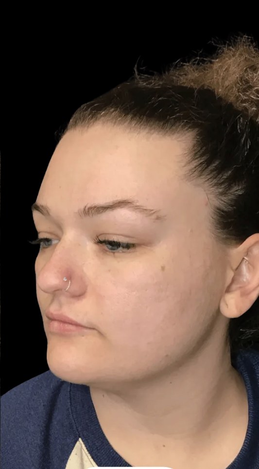 Standard Microneedling after treatment at Juvly Aesthetics