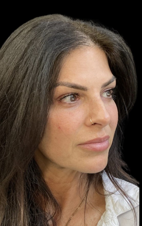 JLyft Non-Surgical Facelift after treatment at Juvly Aesthetics