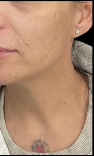Chemical Peel after treatment at Juvly Aesthetics