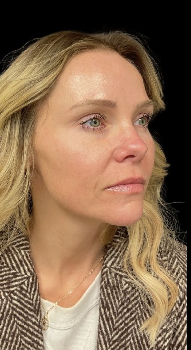 JLyft Non-Surgical Facelift after treatment at Juvly Aesthetics