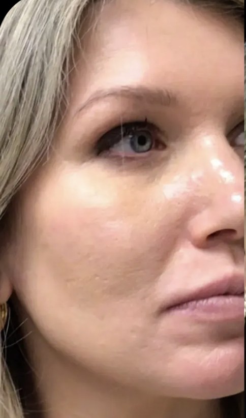 Standard Microneedling before treatment at Juvly Aesthetics