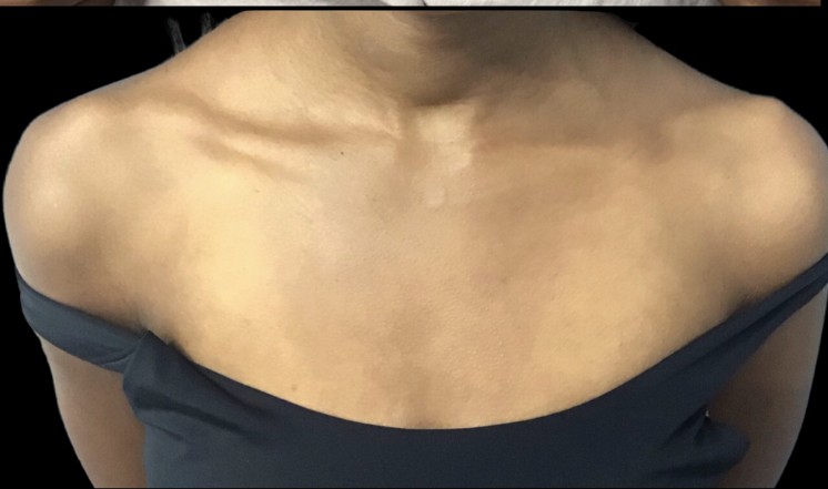 Chemical Peel after treatment at Juvly Aesthetics