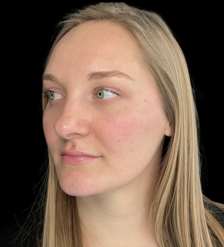 Chin Filler after treatment at Juvly Aesthetics