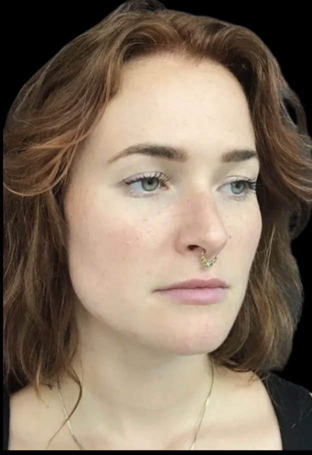 Lip filler before treatment at Juvly Aesthetics